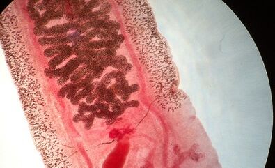 Anquilostomosis in humans