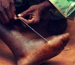 Parasites in one's feet