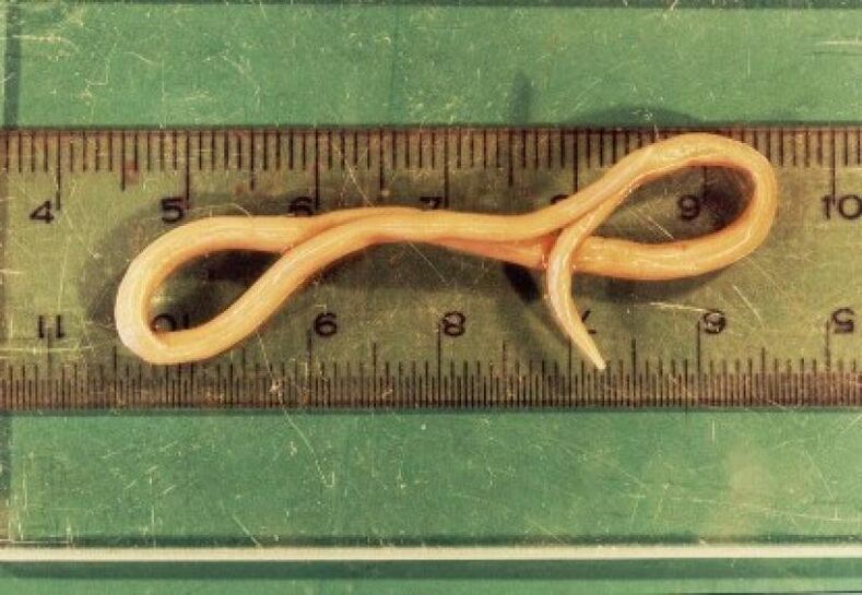 parasitic worms from the human body
