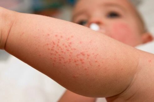 Allergies in children as a symptom of the presence of worms