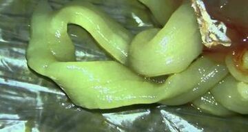 worms from the human body